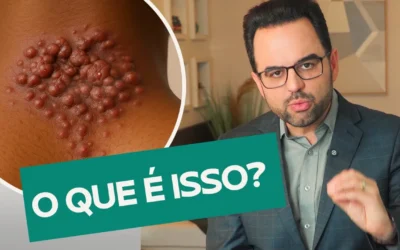 Como tirar marcas da pele? O Alerta Médico sobre as Cicatrizes da Acne Queloideana