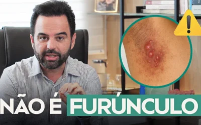 Furúnculos que não melhoram? O Alerta Clínico para a Hidradenite Supurativa