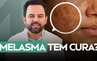 Melasma tem cura? O que a ciência descobriu (e o que ainda falta saber)