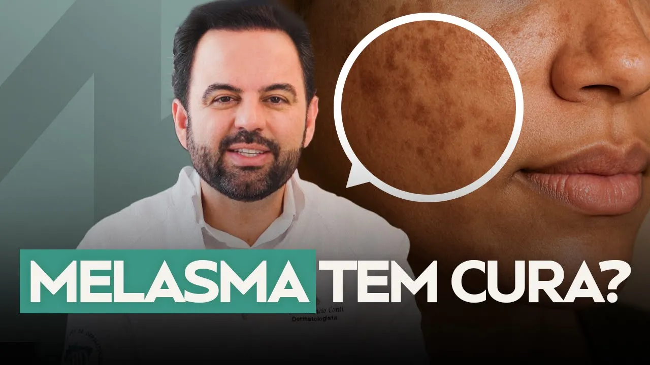 Melasma tem cura? O que a ciência descobriu (e o que ainda falta saber)